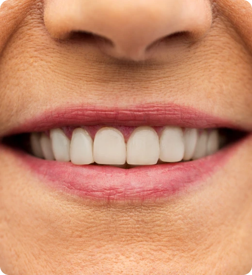 Resultado alinhadores invisíveis