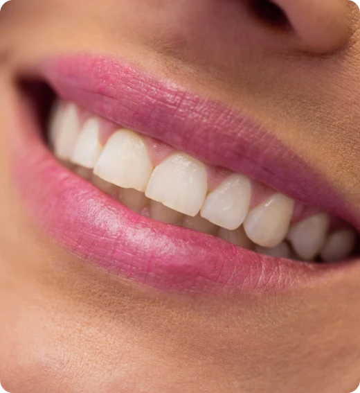 Resultado alinhadores invisíveis