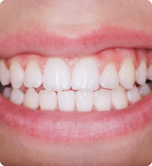 Resultado alinhadores invisíveis